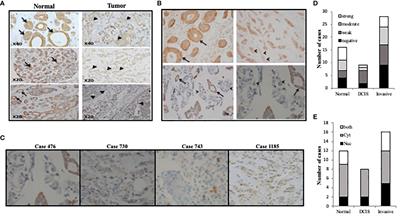 TET1 Isoforms Have Distinct Expression Pattern, Localization and Regulation in Breast Cancer